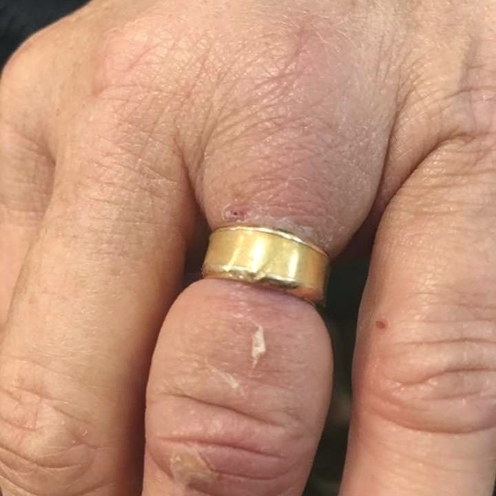 ring-too-tight-on-finger